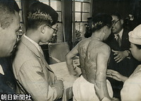 １９４９年、広島を訪れ、アメリカのジャーナリストに初めて自らのケロイドを見せたことで「原爆１号」と呼ばれていた吉川清さんの背中一面のケロイドと手術痕の説明を受ける三笠宮さま